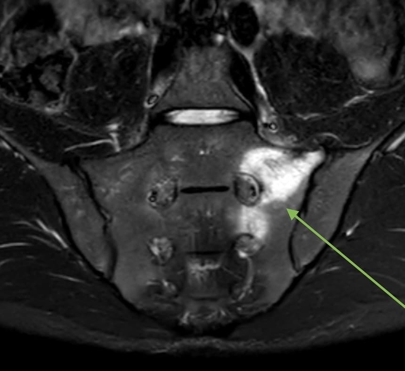 sacrum_stress_fracture